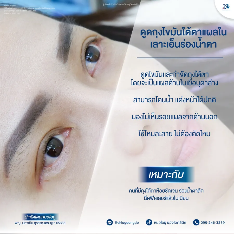เทคนิคดูดไขมันใต้ตาแผลใน