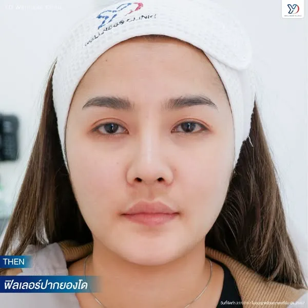 ฟิลเลอร์ปาก ก่อนทำ