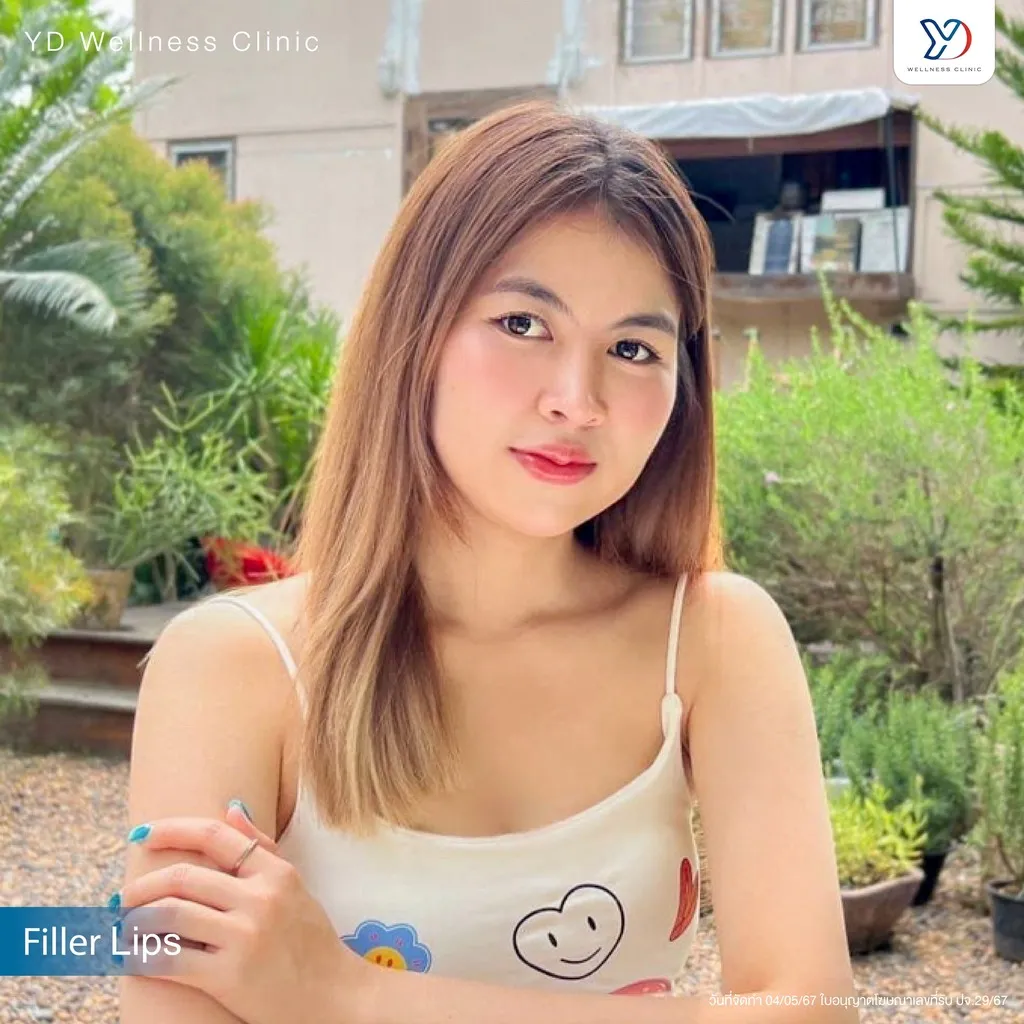 ภาพบุคคลคนไข้ฟิลเลอร์ปาก-02