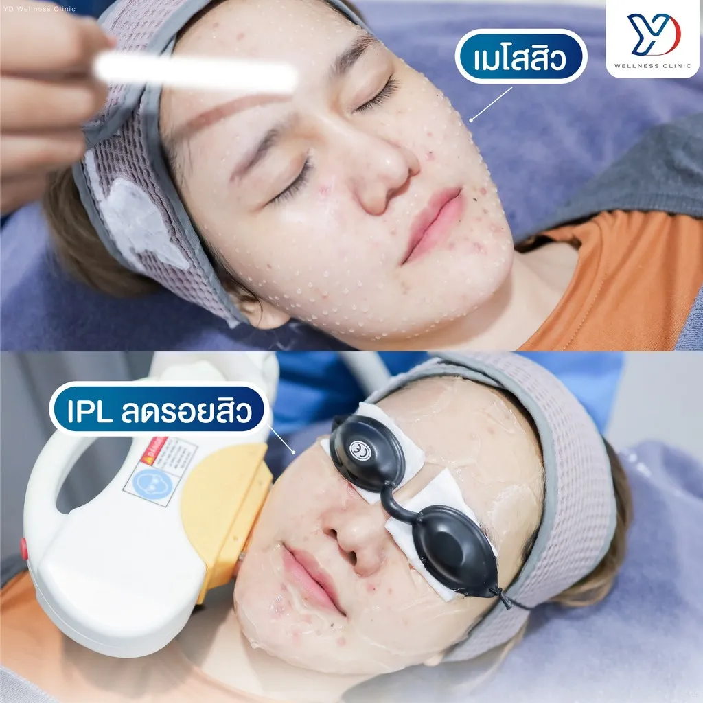 การรักษาสิวด้วย Meso และ IPL