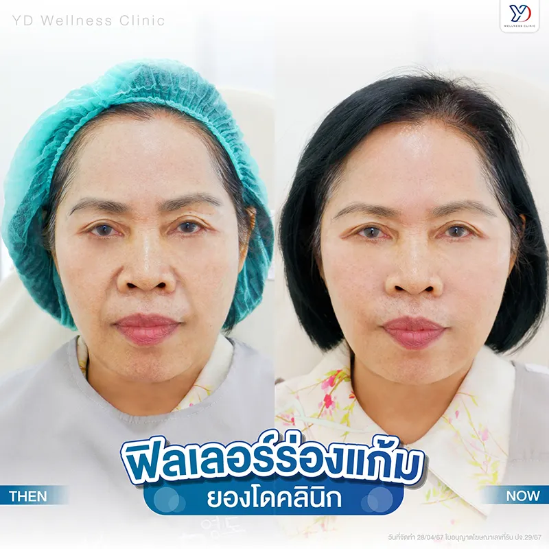 ฟิลเลอร์ร่องแก้ม ก่อน-หลัง