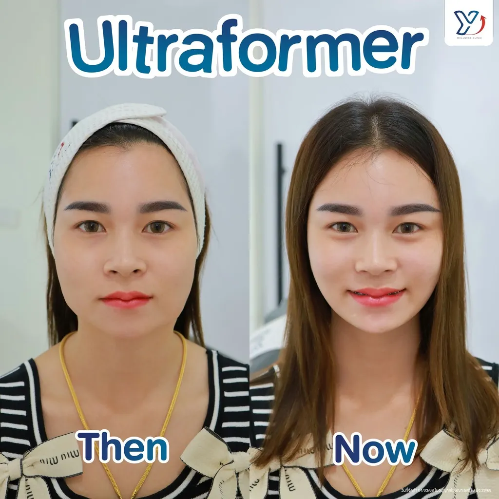 Ultraformer ก่อน-หลัง