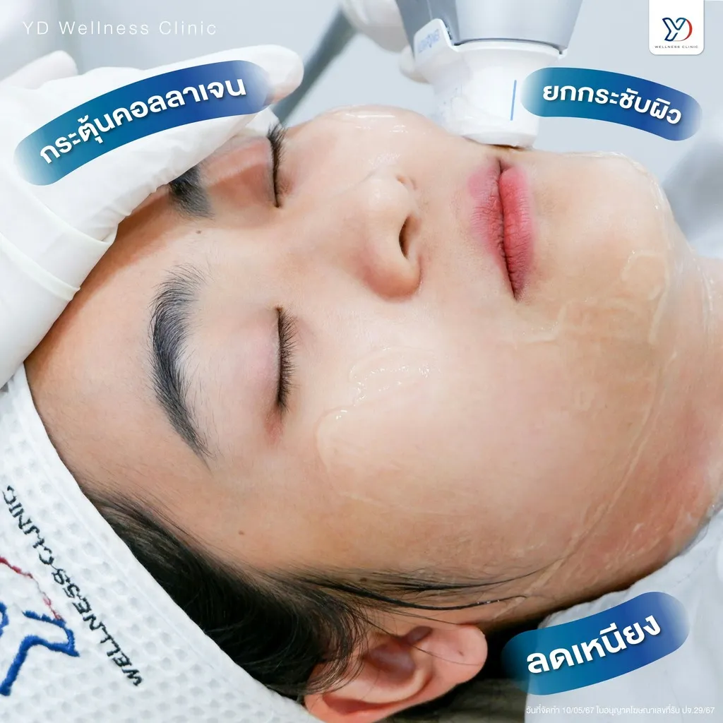 Ultraformer กระตุ้นคอลลาเจน ยกกระชับผิว ลดเหนียง