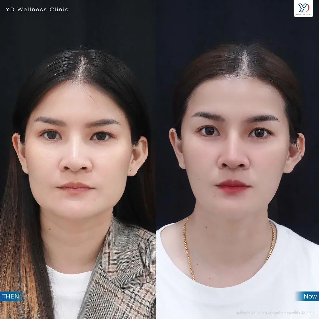 Ultraformer มุมด้านหน้า ก่อน-หลัง