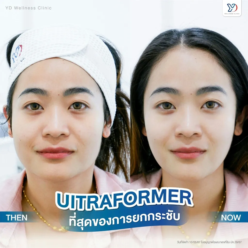 Ultraformer ที่สุดของการยกกระชับ