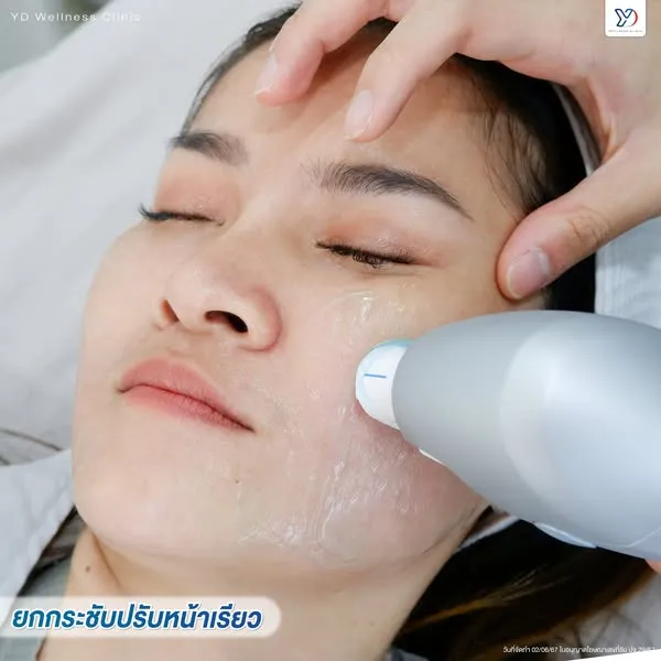Ultraformer ยกกระชับผิวหน้า