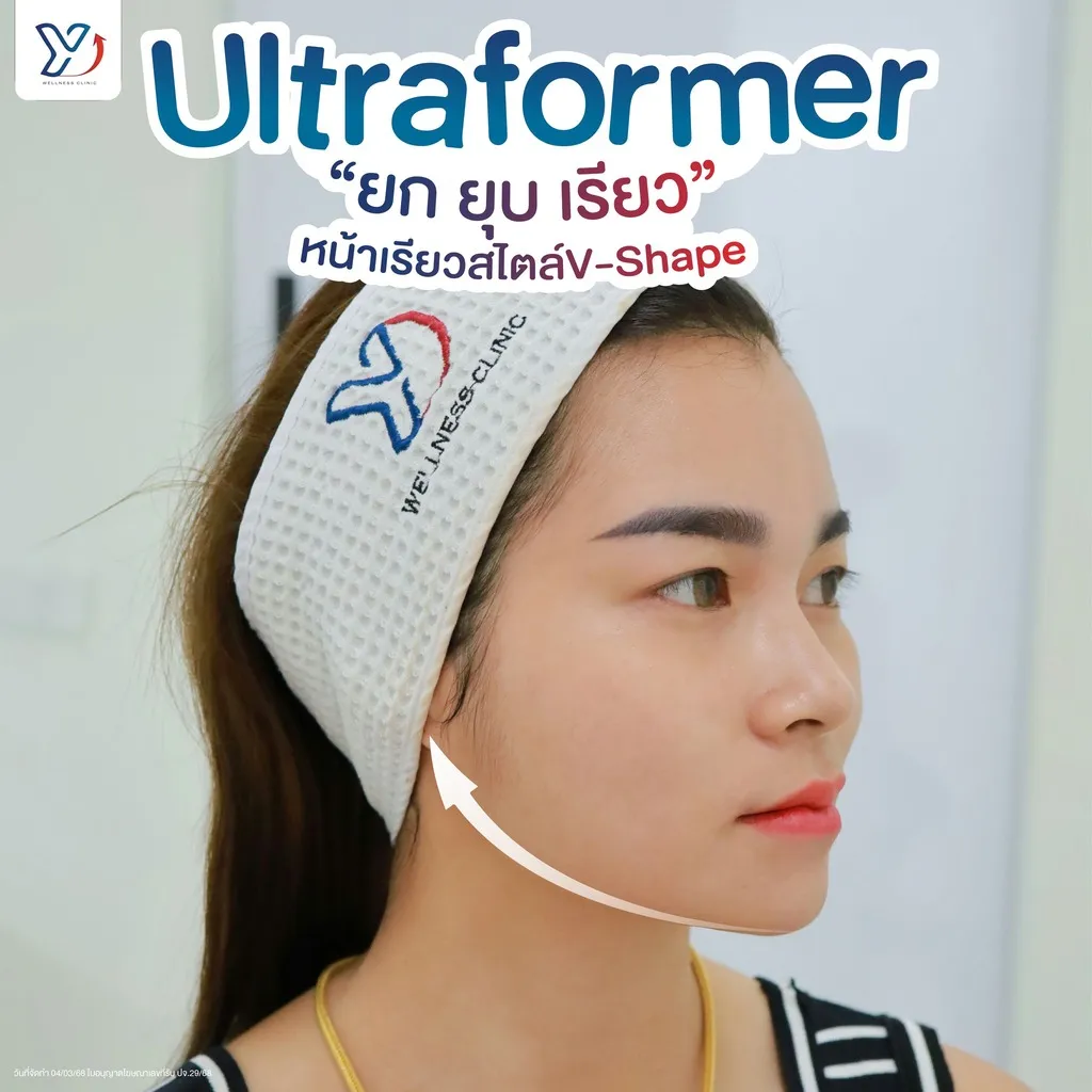 Ultraformer ยกหน้าเรียว V-Shape