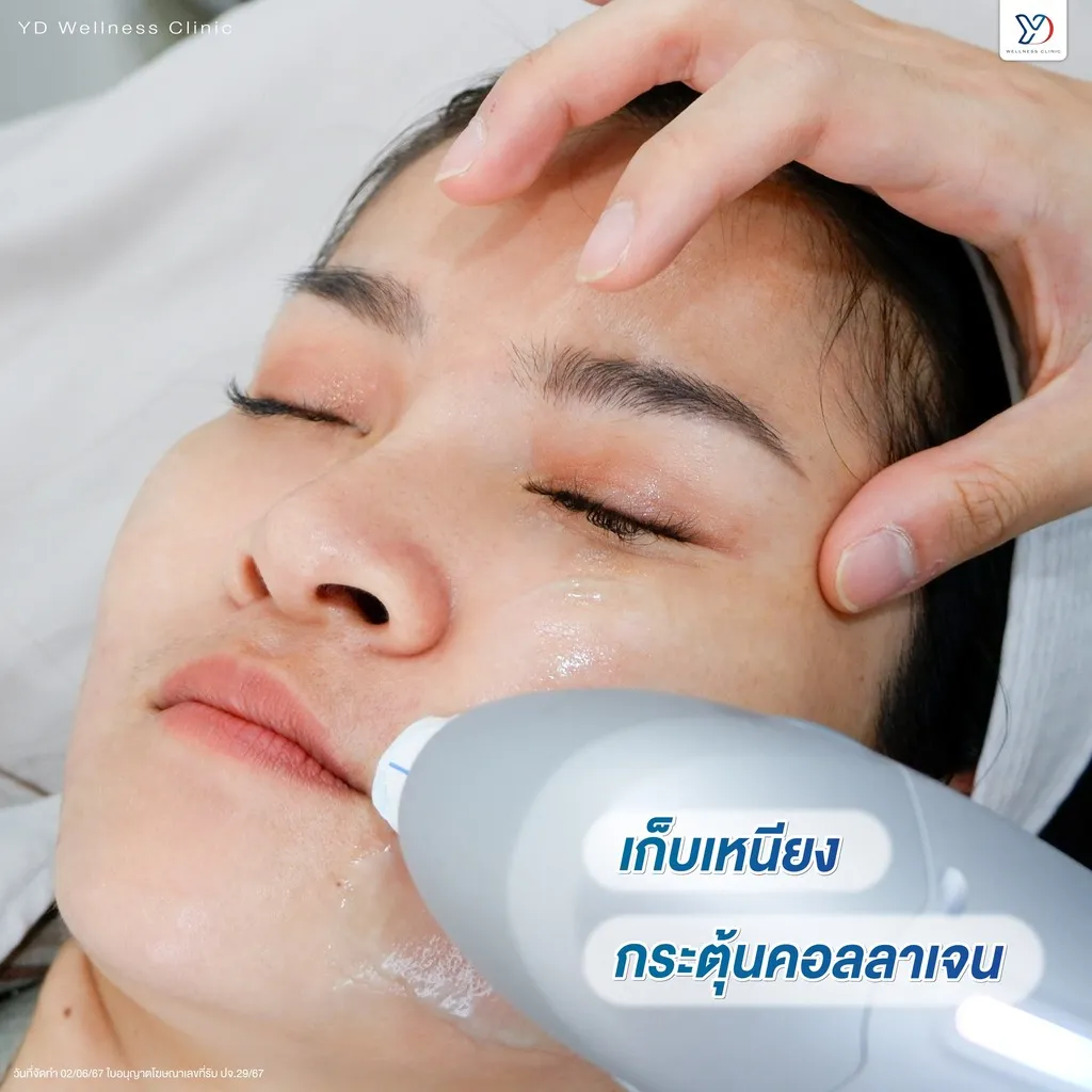 Ultraformer ลดเหนียงและกระตุ้นคอลลาเจน