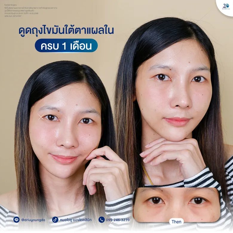 ดูดไขมันใต้ตาแผลใน อัปเดต 1 เดือน