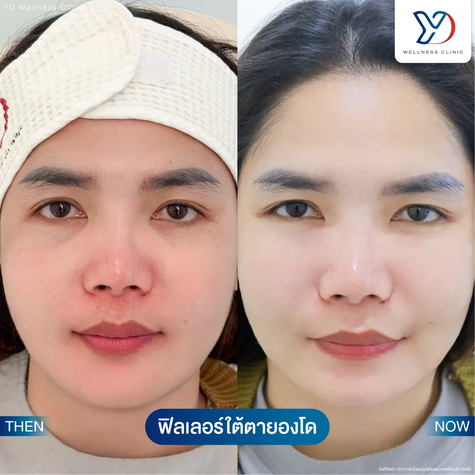 ฟิลเลอร์ใต้ตา ก่อน-หลัง-02