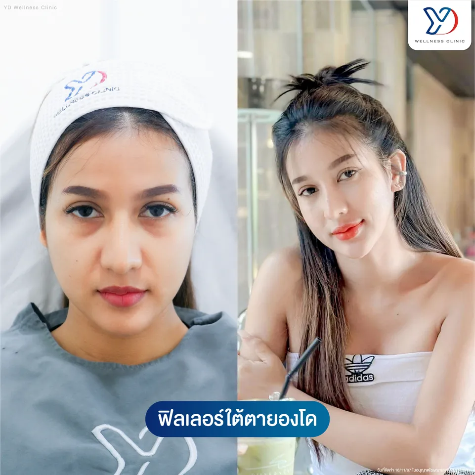 ฟิลเลอร์ใต้ตา ก่อน-หลัง (ภาพบุคคล)