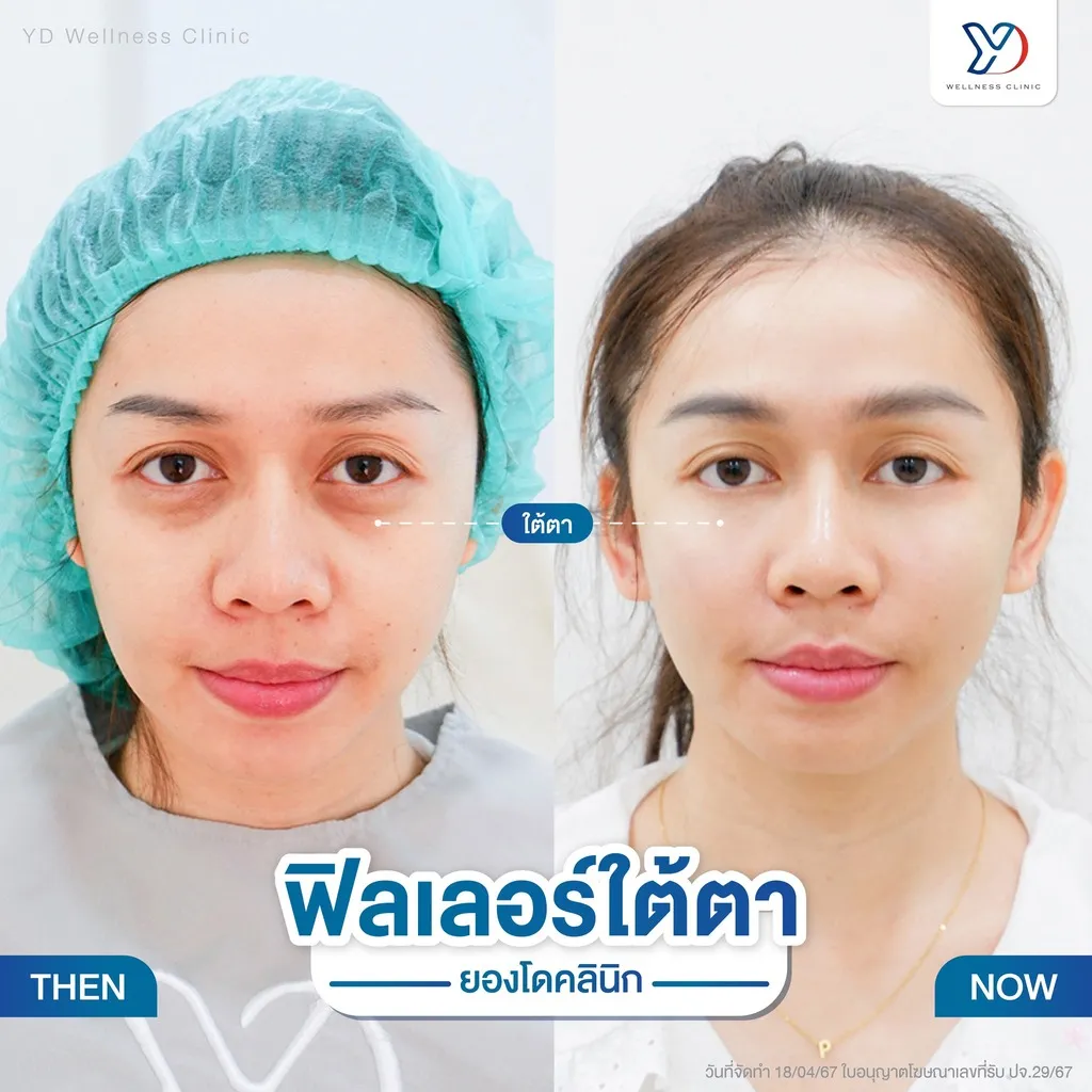 ฟิลเลอร์ใต้ตา ก่อน-หลัง