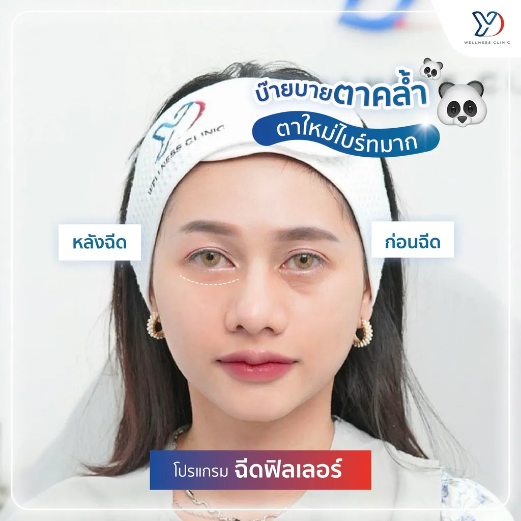 การฉีดฟิลเลอร์ใต้ตาแก้ตาคล้ำ