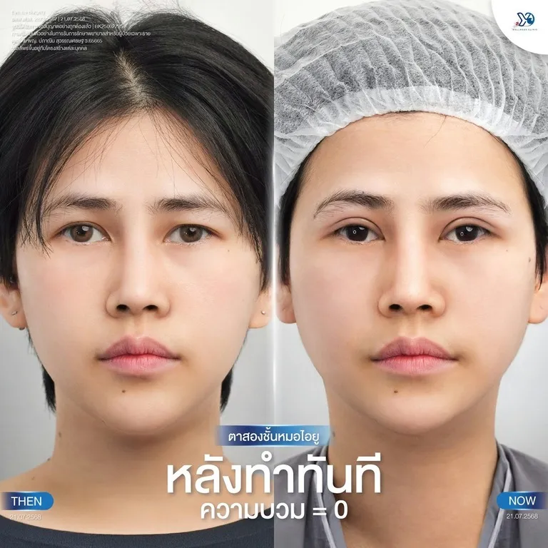 ตาสองชั้นหมอไอยู หลังทำทันที ความบวม=0