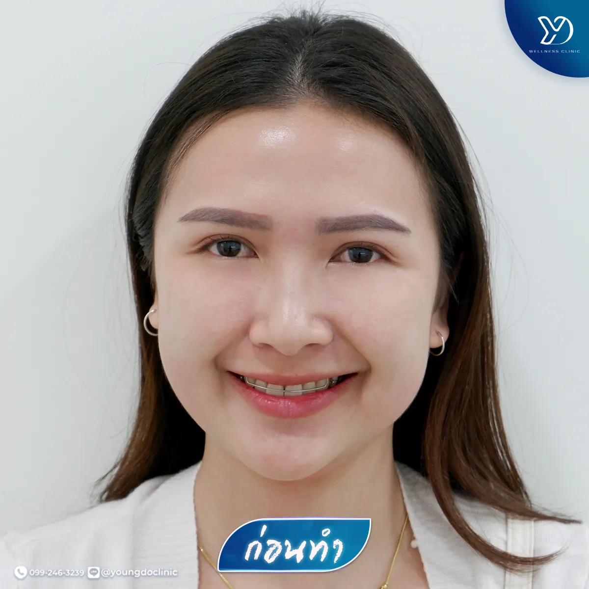 ก่อนทำทรีทเมนต์ลดแก้ม