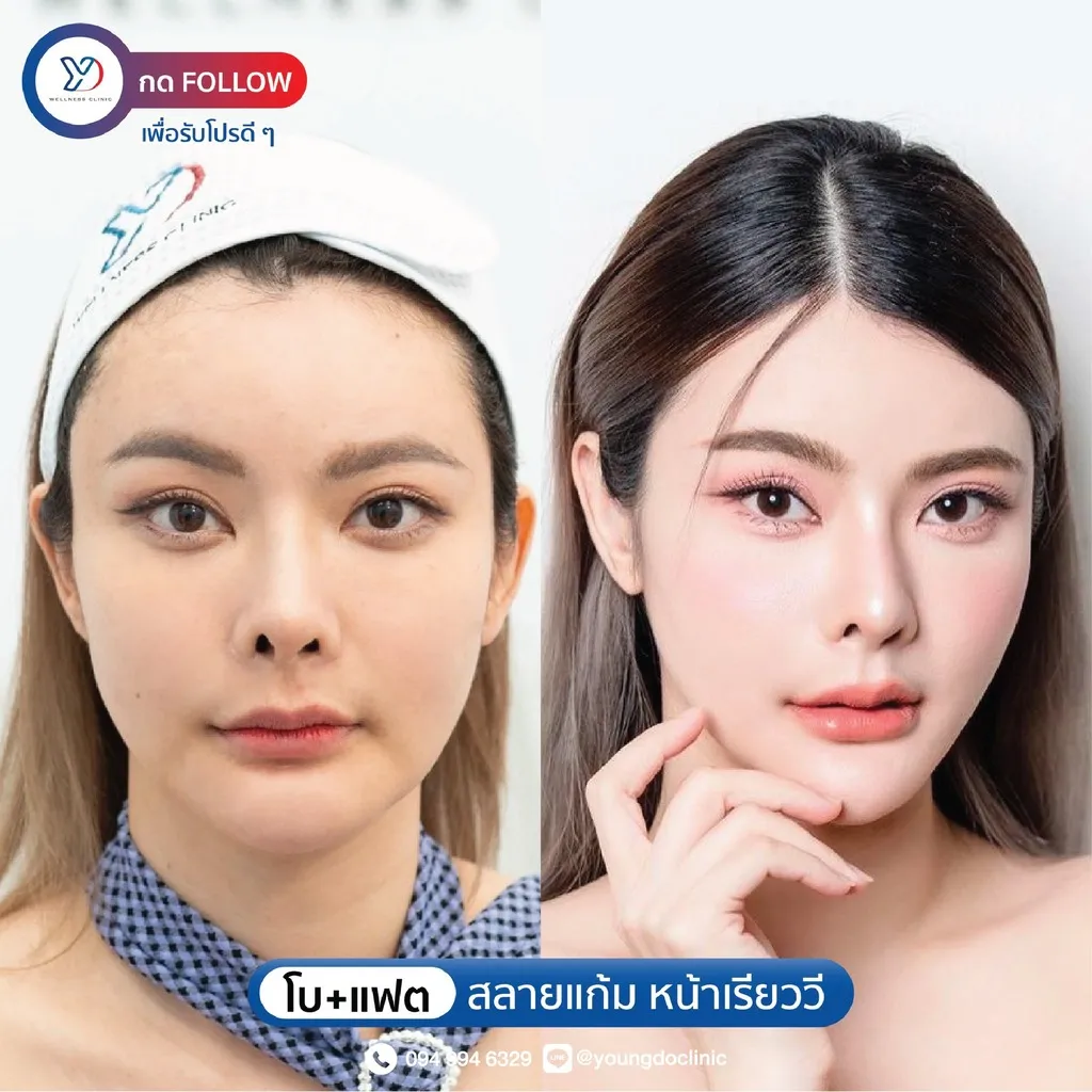 โบท็อกซ์และฉีดสลายไขมัน ก่อน-หลัง