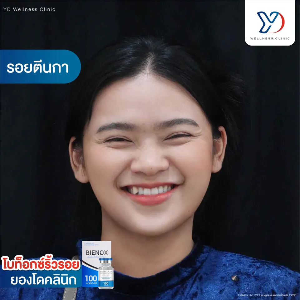 โบท็อกซ์ลดรอยตีนกา หลังทำ