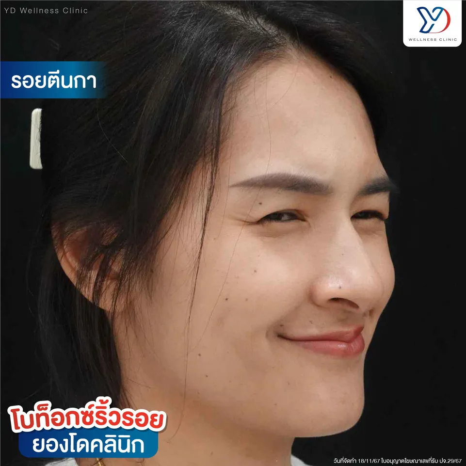 โบท็อกซ์ลดรอยตีนกา ก่อนทำ