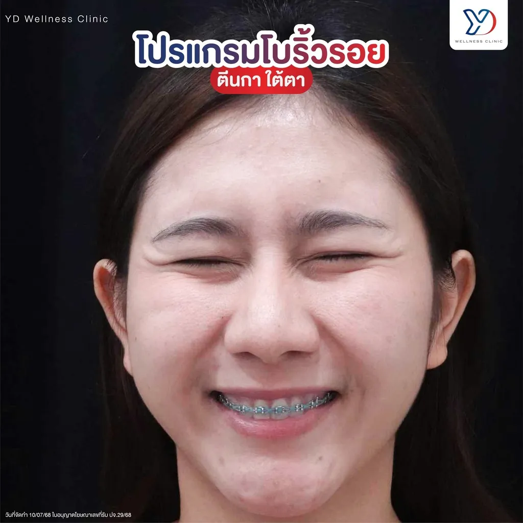 โบท็อกซ์ลดริ้วรอยตีนกาและใต้ตา
