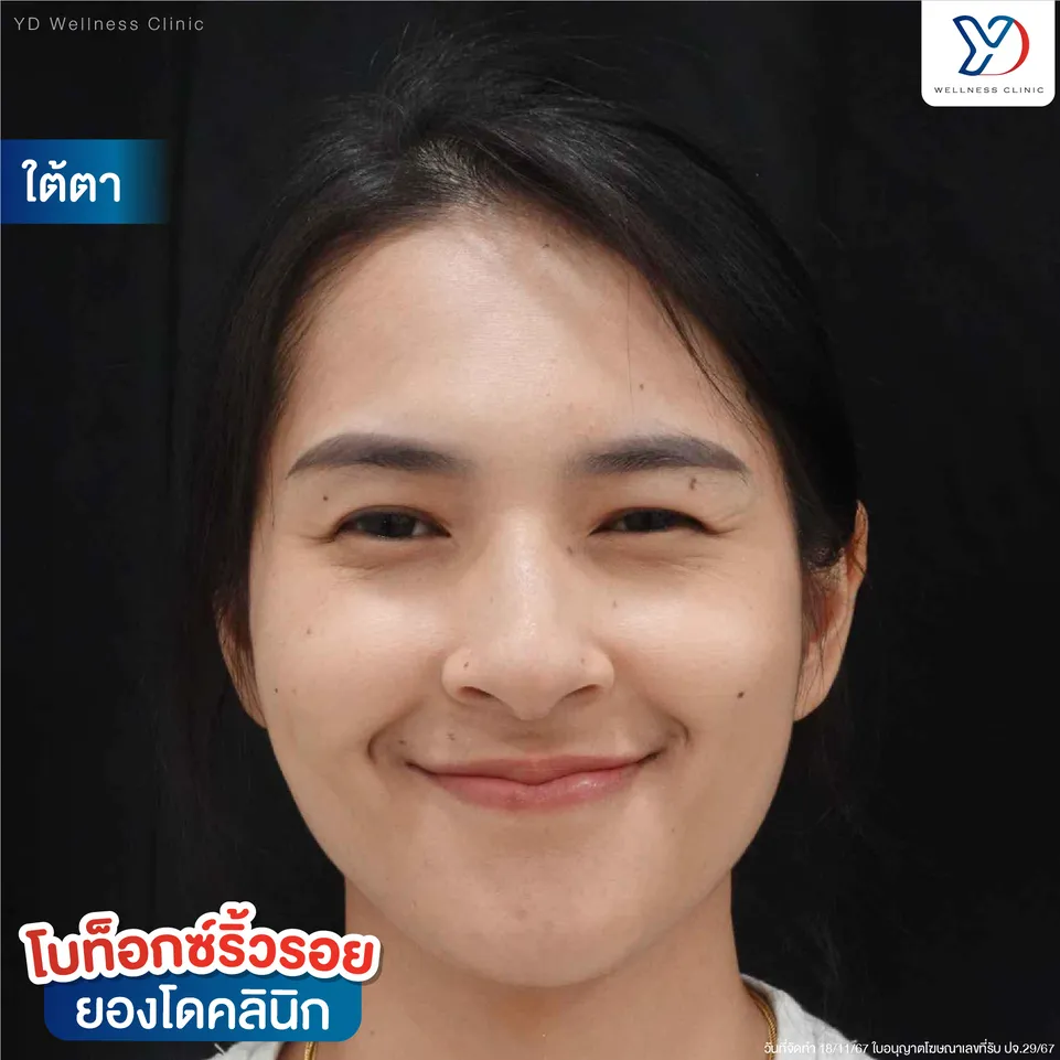 โบท็อกซ์ลดริ้วรอยใต้ตา ก่อนทำ