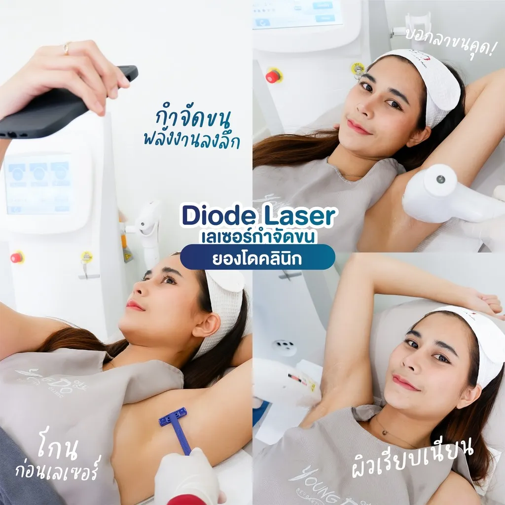 ขั้นตอนการโกนและทำ Diode Laser