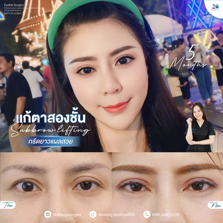 การแก้ตาสองชั้น หลัง 5 เดือน