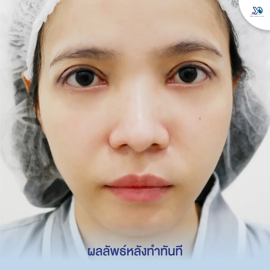 ผลลัพธ์การแก้ตาสองชั้นทันทีหลังทำ