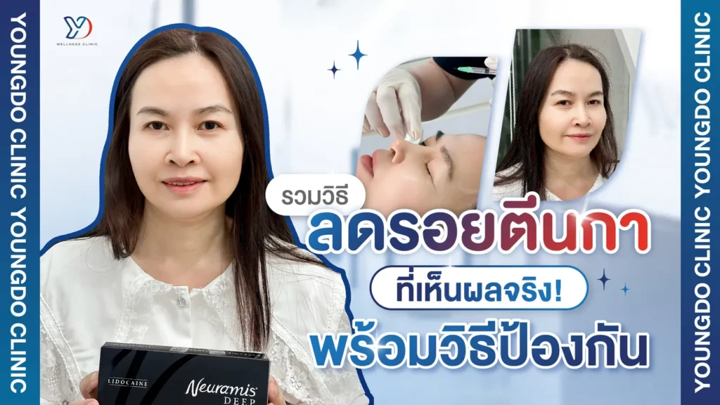 รวมวิธีลดรอยตีนกาที่เห็นผลจริง! พร้อมวิธีป้องกัน