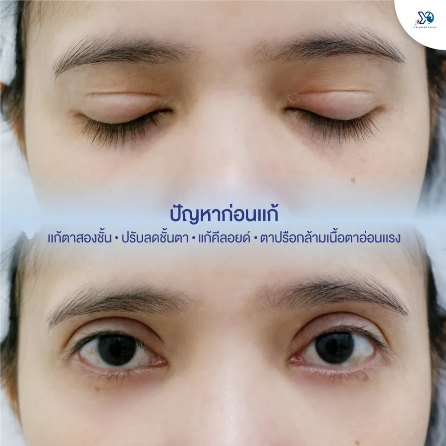 ปัญหาก่อนการแก้ตาสองชั้น