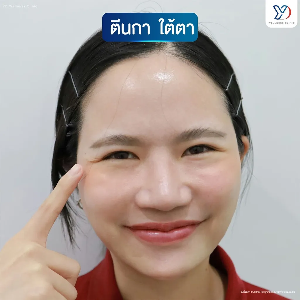 การระบุรอยตีนกาและปัญหาใต้ตา