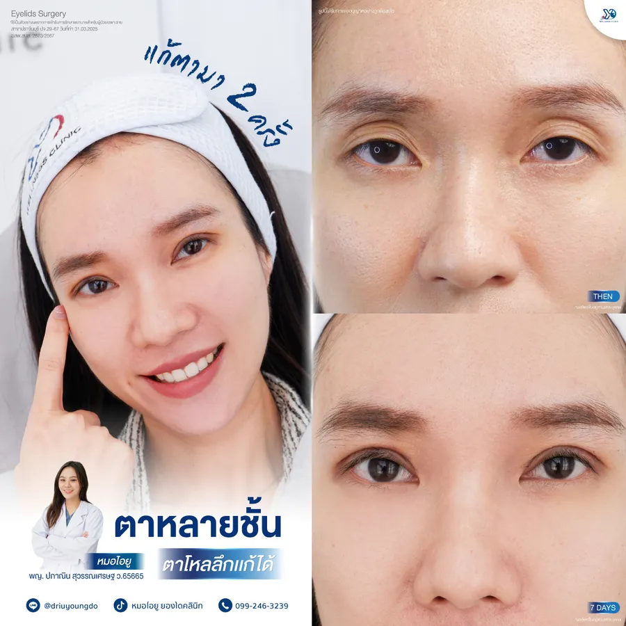 การแก้ไขปัญหาหลายชั้นตา อัปเดต 7 วัน