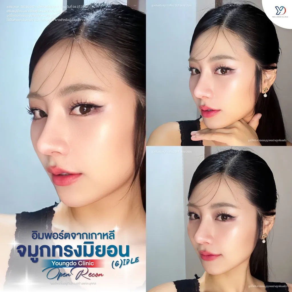 เสริมจมูก Open Recon ทรงไอดอล