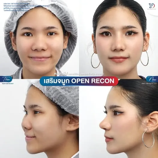 เสริมจมูก Open Recon ก่อน-หลัง