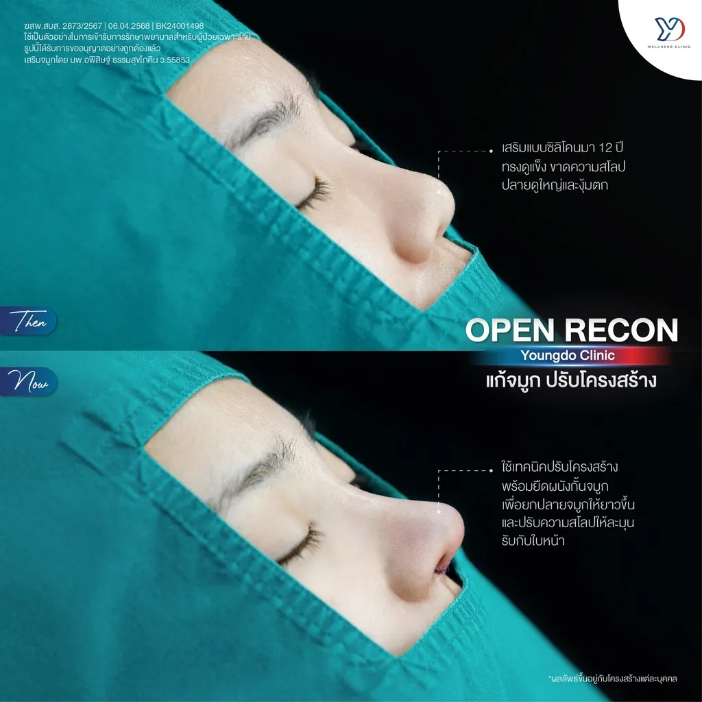 การแก้จมูก Open Recon และปรับโครงสร้าง