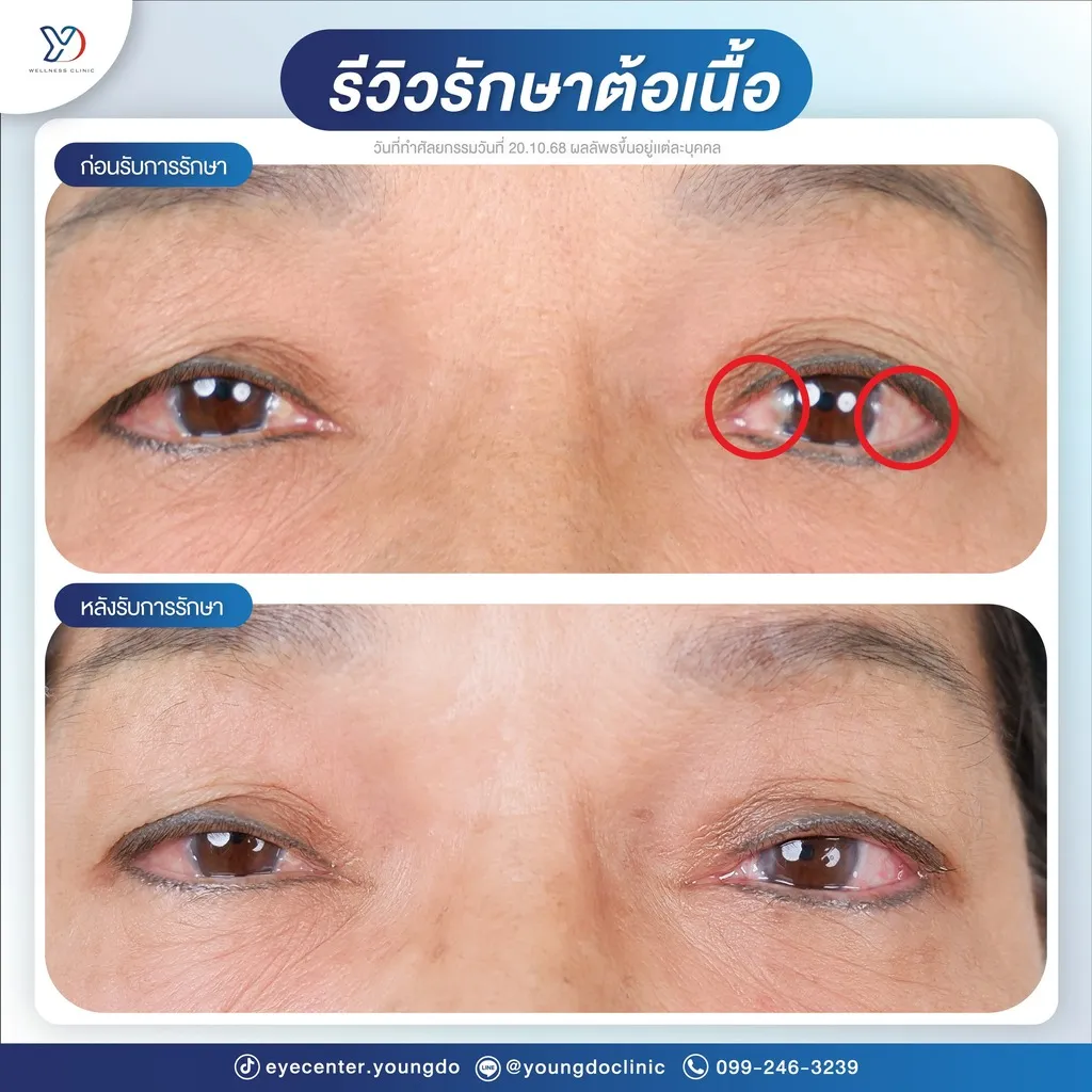 รีวิวการรักษาต้อเนื้อ ก่อน-หลัง