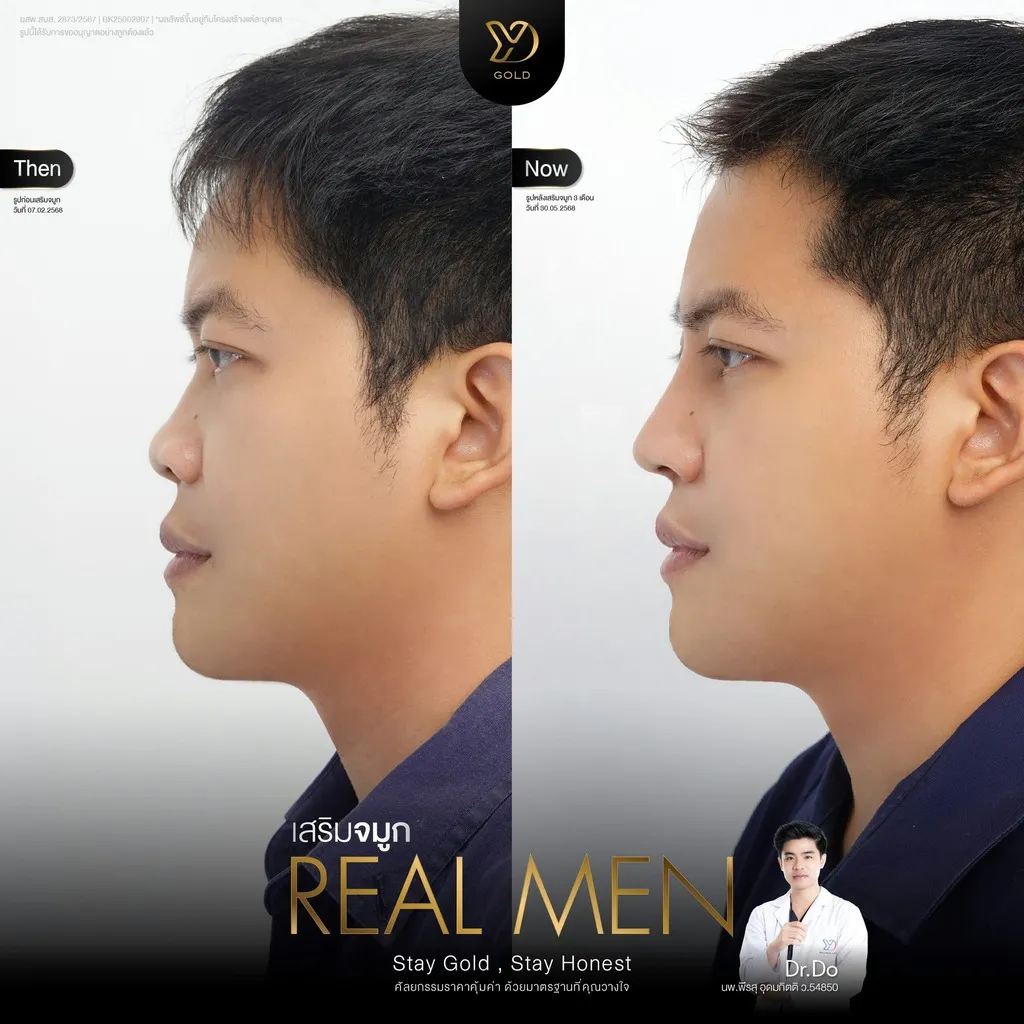 เสริมจมูก Real Men ก่อน-หลัง
