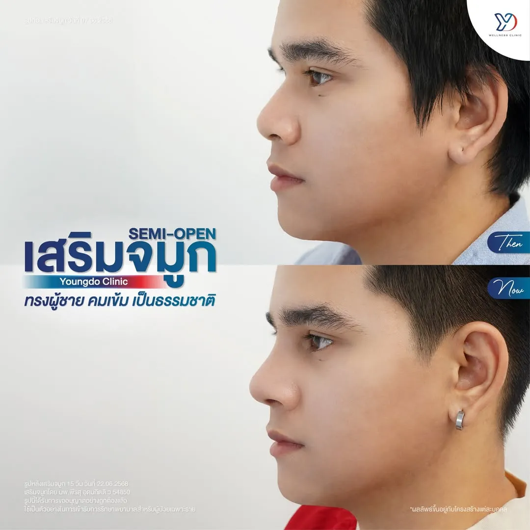 เสริมจมูกผู้ชาย Semi-Open ก่อน-หลัง