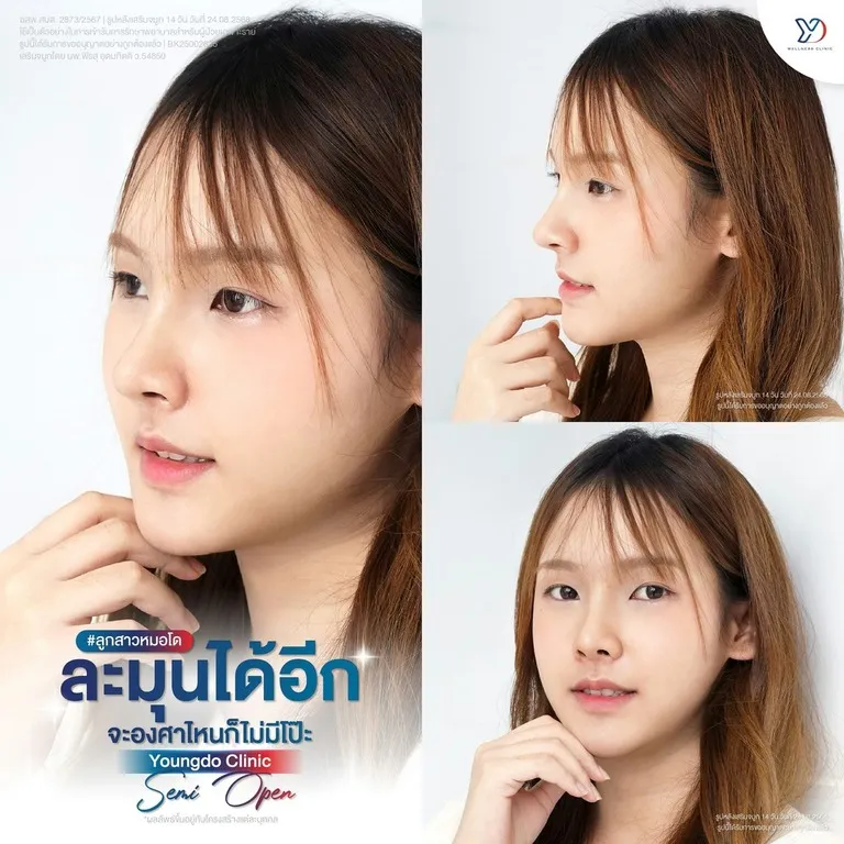 เสริมจมูก Semi-Open ทรงละมุนเป็นธรรมชาติ