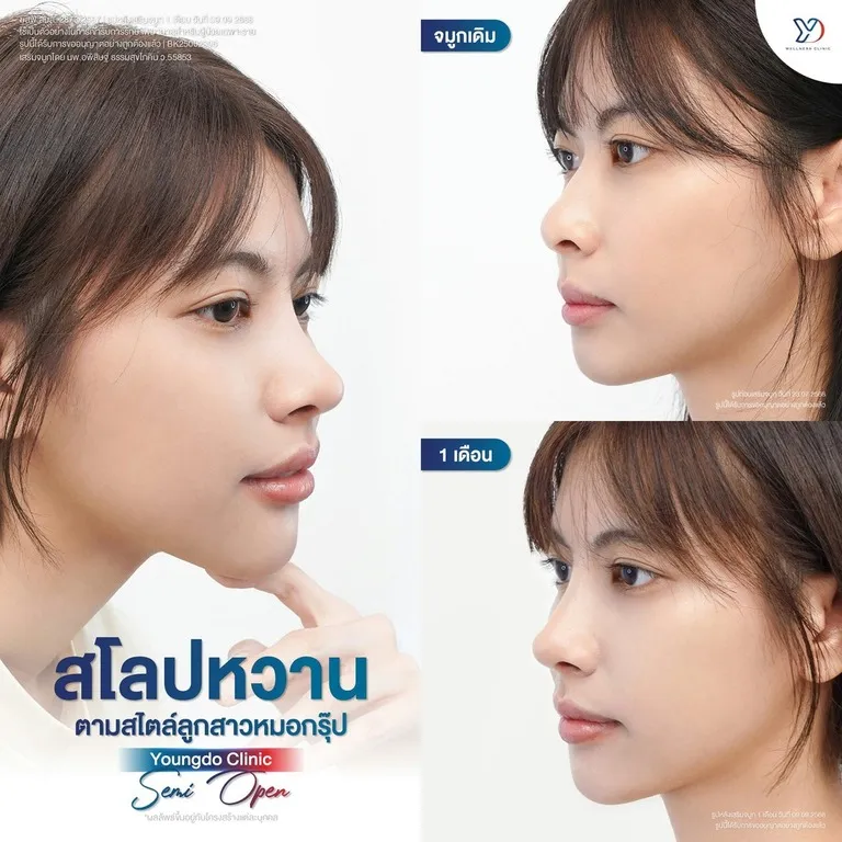 อัปเดตเสริมจมูก Semi-Open 1 เดือน