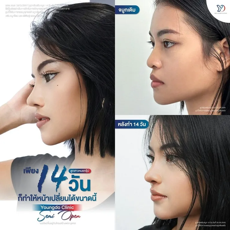 ผลลัพธ์เสริมจมูก Semi-Open 14 วัน