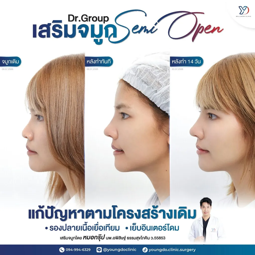 อัปเดตเสริมจมูก Semi-Open 14 วัน