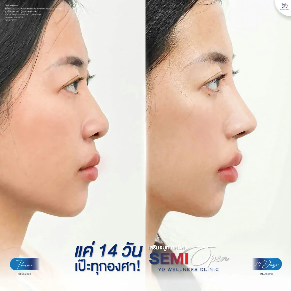 อัปเดตเสริมจมูก Semi-Open 14 วัน