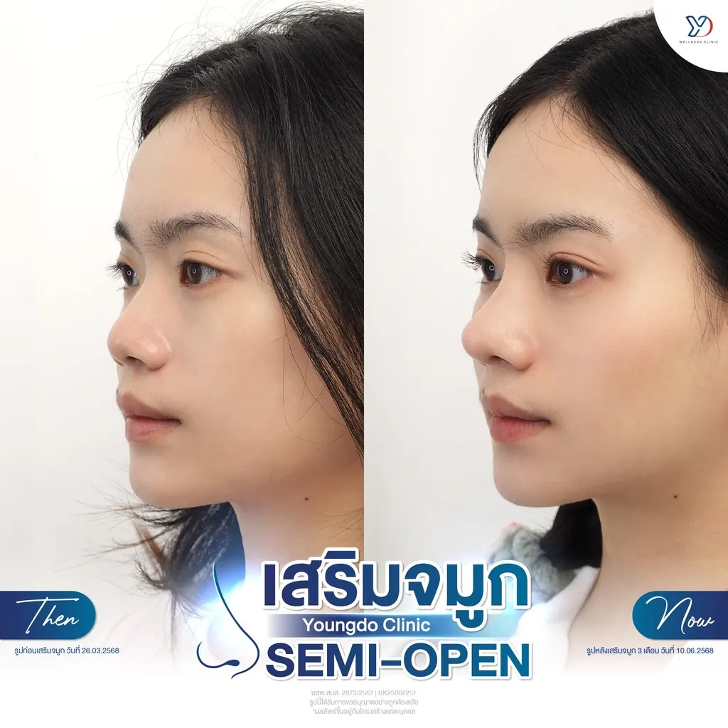 อัปเดตเสริมจมูก Semi-Open 3 เดือน
