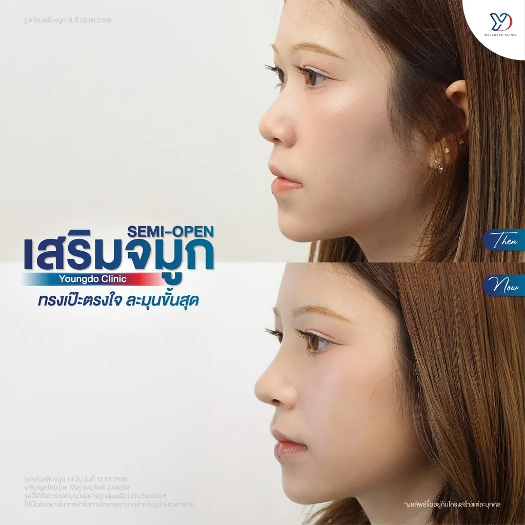 เสริมจมูก SEMI-OPEN ทรงเป๊ะตรงใจ ละมุนขั้นสุด