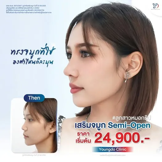 เสริมจมูก Semi-Open ทรงจมูกที่ใช่ องศาไหนก็ละมุน