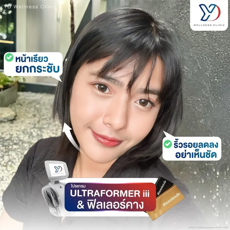 ผลลัพธ์ Ultraformer และฟิลเลอร์คาง