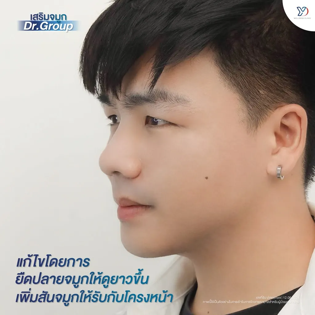 ภาพหลังการเสริมจมูก