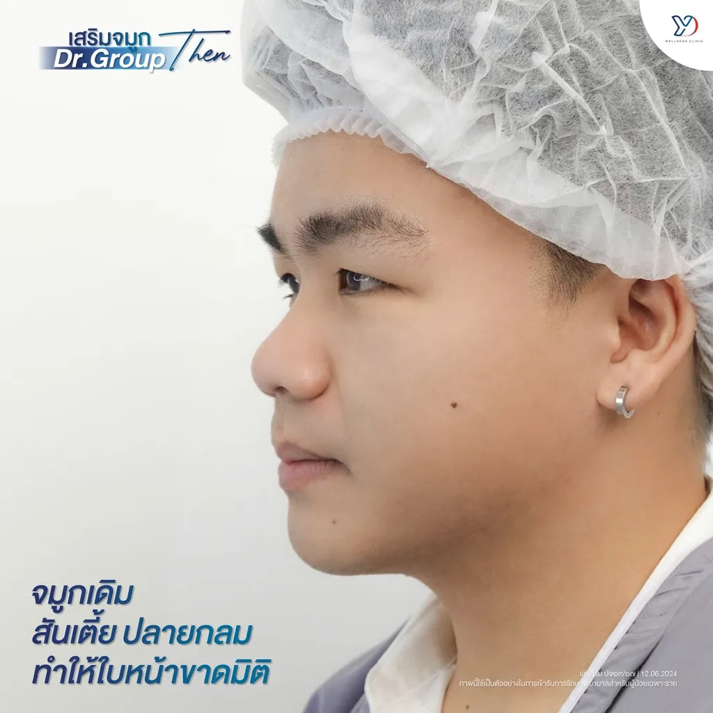 ภาพก่อนการเสริมจมูก