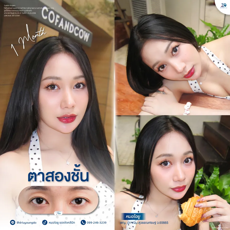 ผลลัพธ์หลังการทำตาสองชั้น