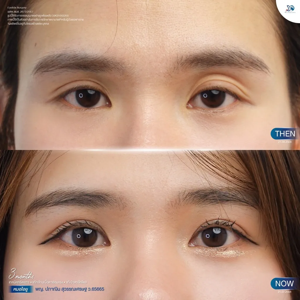 เทคนิคการทำตาสมัยใหม่